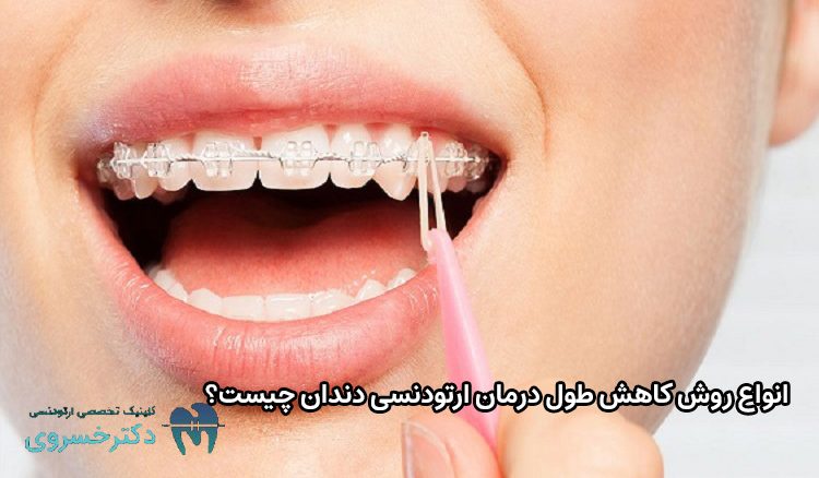 انواع روش کاهش طول درمان ارتودنسی دندان