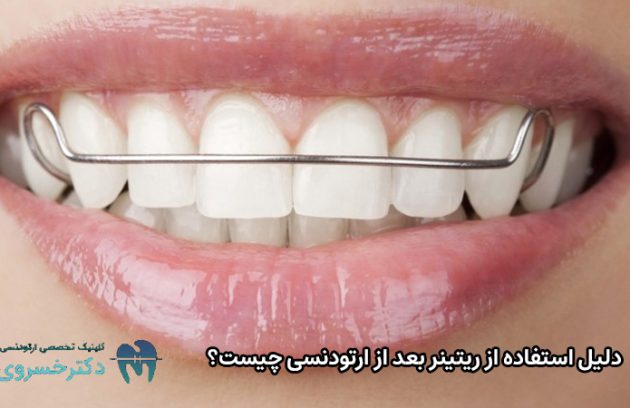 دلیل استفاده از ریتینر بعد از ارتودنسی