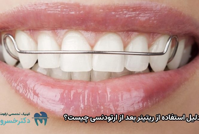 دلیل استفاده از ریتینر بعد از ارتودنسی