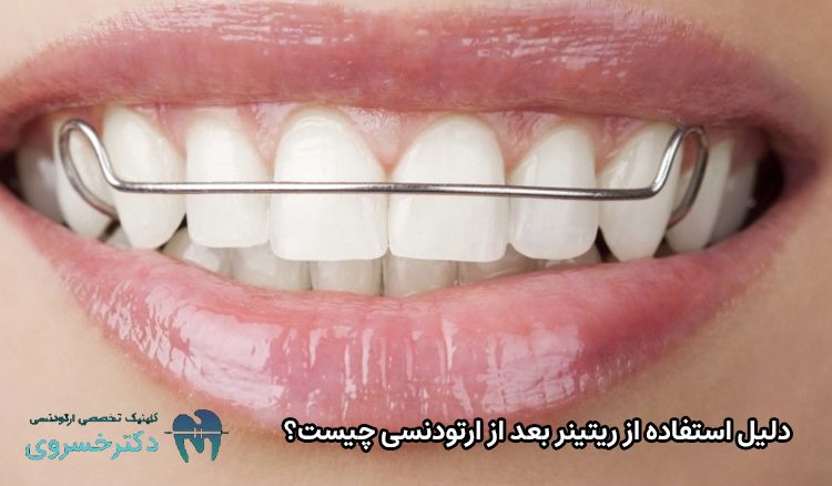 دلیل استفاده از ریتینر بعد از ارتودنسی
