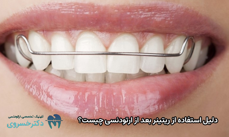 دلیل استفاده از ریتینر بعد از ارتودنسی