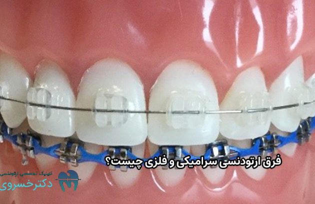 فرق ارتودنسی سرامیکی و فلزی