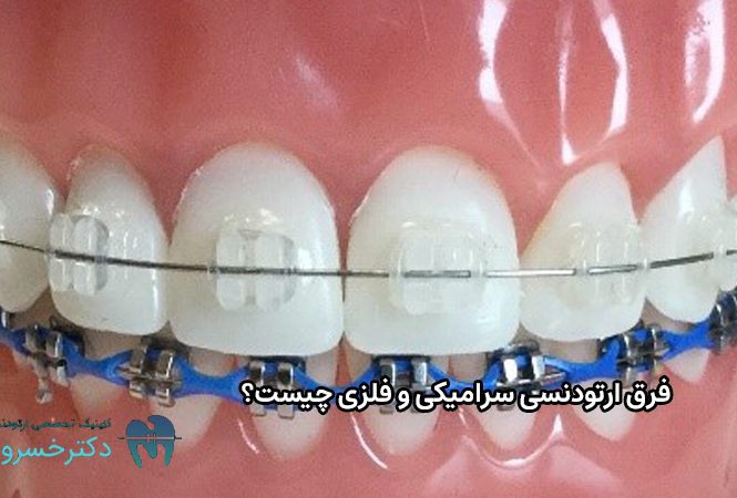 فرق ارتودنسی سرامیکی و فلزی