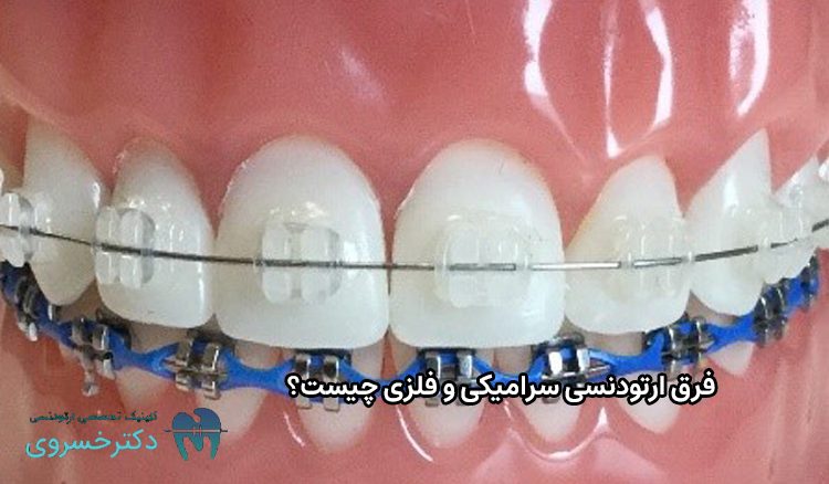 فرق ارتودنسی سرامیکی و فلزی