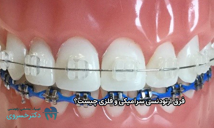 فرق ارتودنسی سرامیکی و فلزی