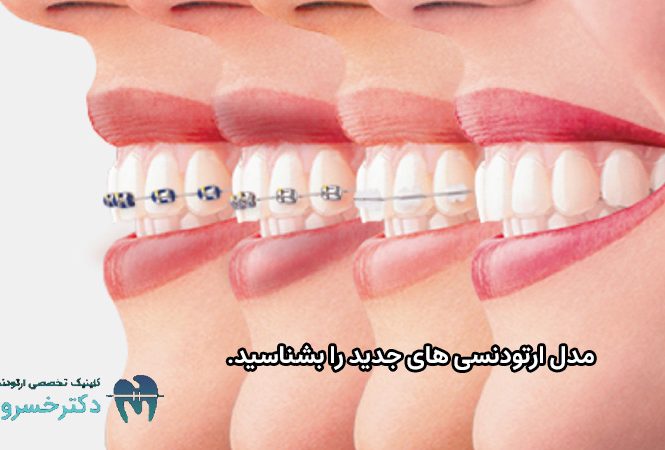 مدل ارتودنسی های جدید