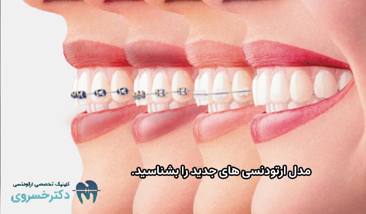 مدل ارتودنسی های جدید
