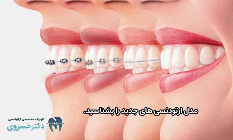 مدل ارتودنسی های جدید