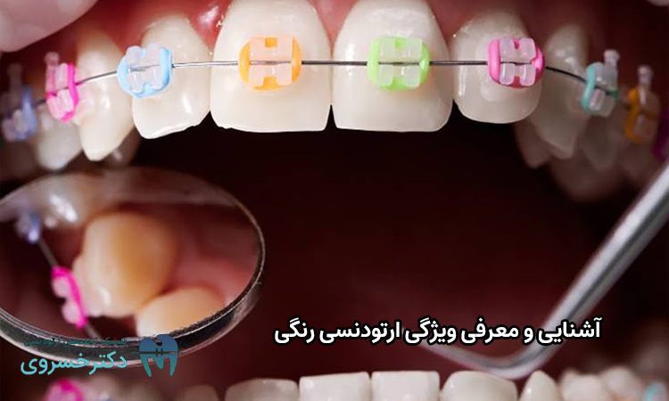 آشنایی با ویژگی ارتودنسی رنگی