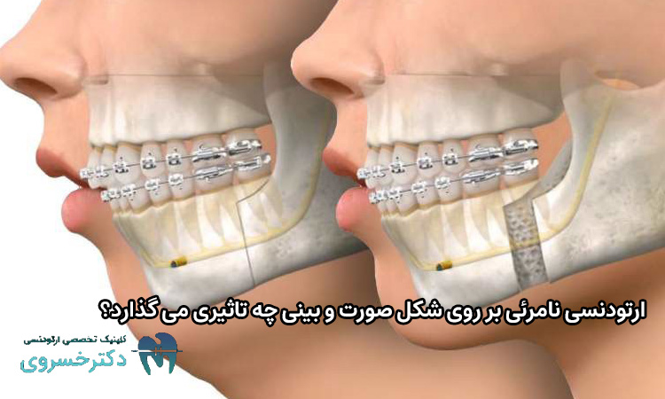 اثر ارتودنسی نامرئی بر روی شکل صورت و بینی