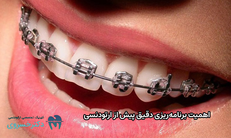 اهمیت برنامهریزی پیش از ارتودنسی