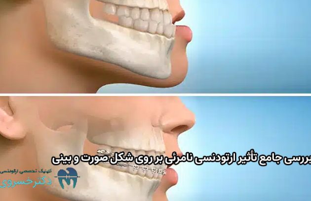 تأثیر ارتودنسی نامرئی بر روی شکل صورت و بینی