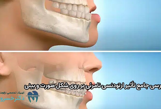 تأثیر ارتودنسی نامرئی بر روی شکل صورت و بینی