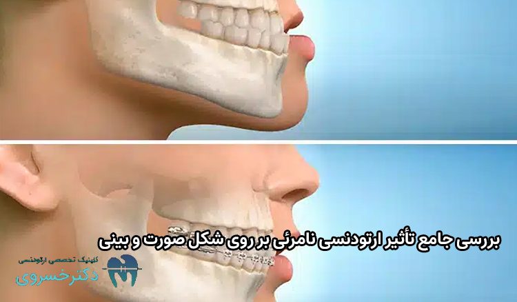تأثیر ارتودنسی نامرئی بر روی شکل صورت و بینی