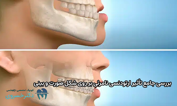 تأثیر ارتودنسی نامرئی بر روی شکل صورت و بینی