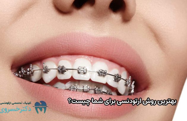 بهترین روش ارتودنسی