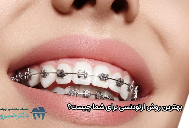 بهترین روش ارتودنسی