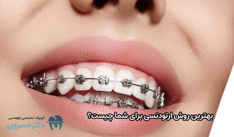بهترین روش ارتودنسی