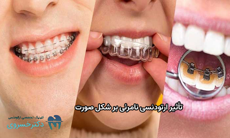 تاثیر ارتودنسی نامرئی بر شکل صورت