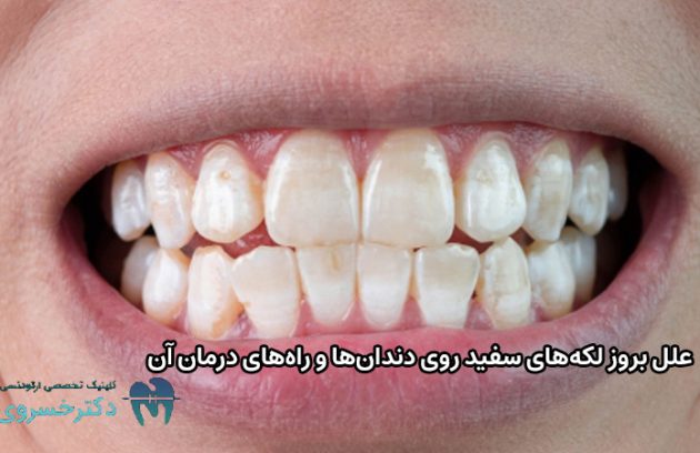 علل بروز لکه‌های سفید دندان‌ها