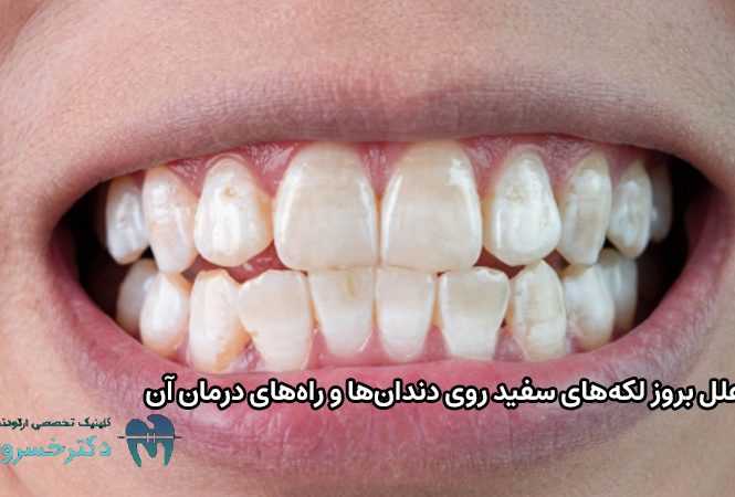 علل بروز لکه‌های سفید دندان‌ها