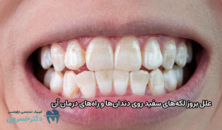 علل بروز لکه‌های سفید دندان‌ها