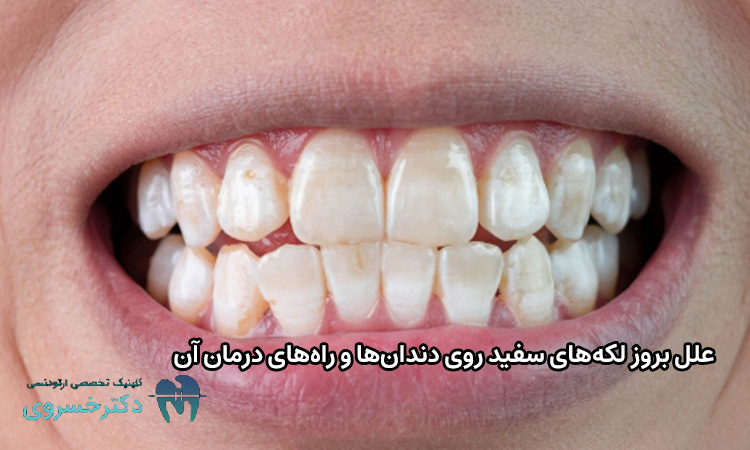 علل بروز لکههای سفید دندانها