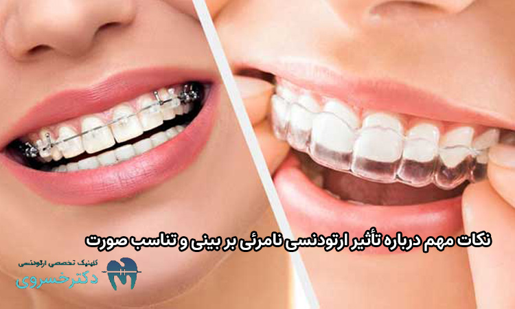 نکات مهم درباره تأثیر ارتودنسی نامرئی بر بینی و تناسب صورت