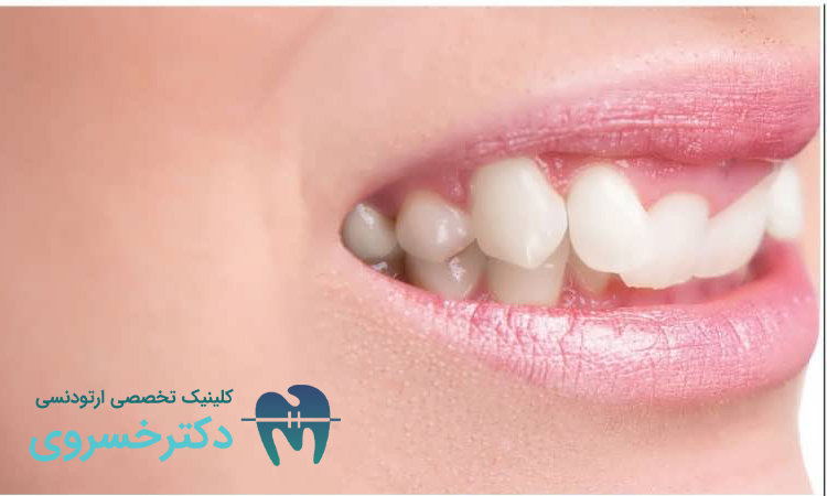 علل بروز کراودینگ دندان