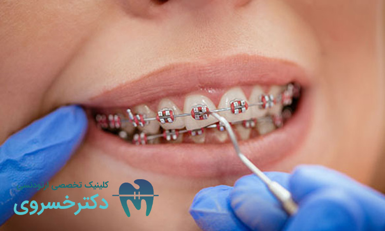 اثرگذاری فشار خون در درمان ارتودنسی
