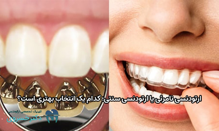 ارتودنسی نامرئی یا ارتودنسی سنتی؟