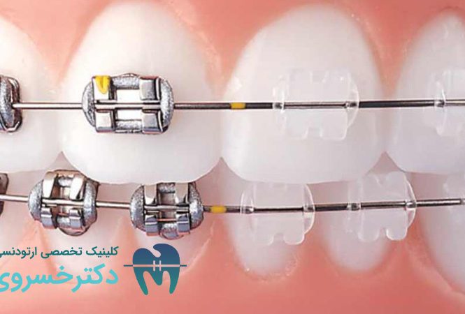 تاثیر فشار خون بر درمان ارتودنسی