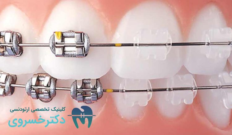 تاثیر فشار خون بر درمان ارتودنسی