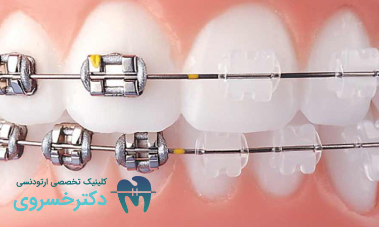 تاثیر فشار خون بر درمان ارتودنسی