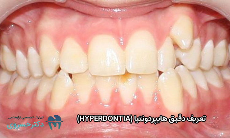 تعریف هایپردونتیا