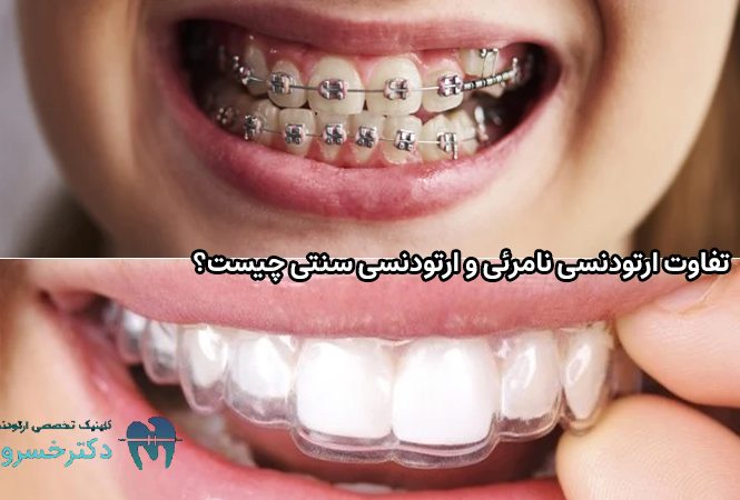 تفاوت ارتودنسی نامرئی و ارتودنسی سنتی