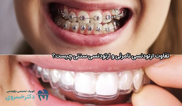 تفاوت ارتودنسی نامرئی و ارتودنسی سنتی