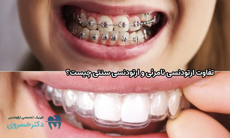 تفاوت ارتودنسی نامرئی و ارتودنسی سنتی