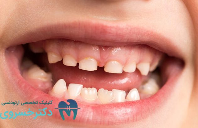 علت کج شدن دندان کودکان