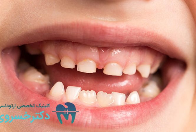 علت کج شدن دندان کودکان