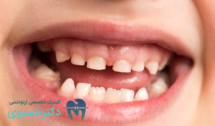 علت کج شدن دندان کودکان