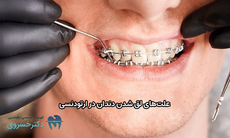 علت لق شدن دندان در ارتودنسی