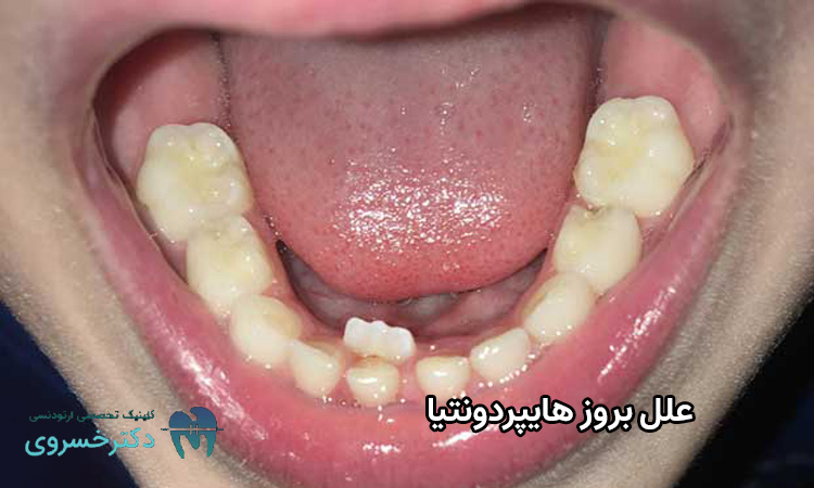 علل بروز هایپردونتیا