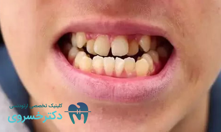 فشار زبان باعث کجی دندان کودکان
