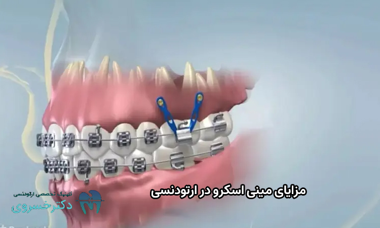 مزایای مینی اسکرو در ارتودنسی