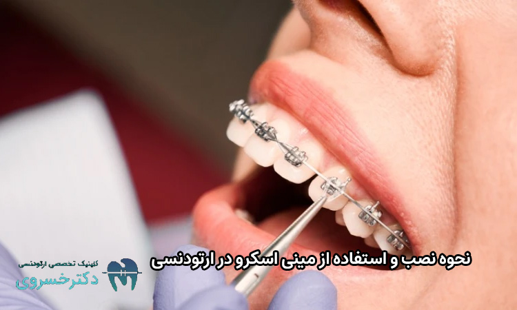 نصب و استفاده از مینی اسکرو در ارتودنسی