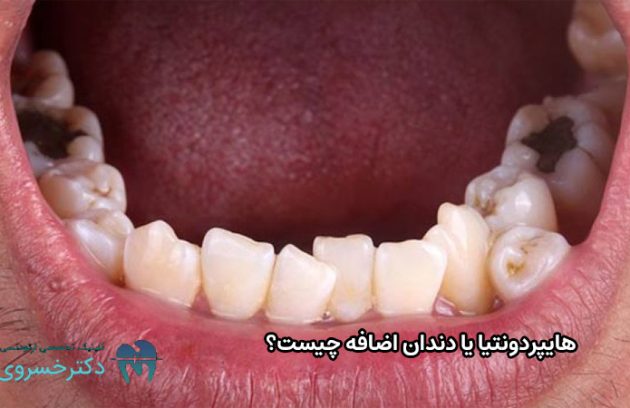 هایپردونتیا