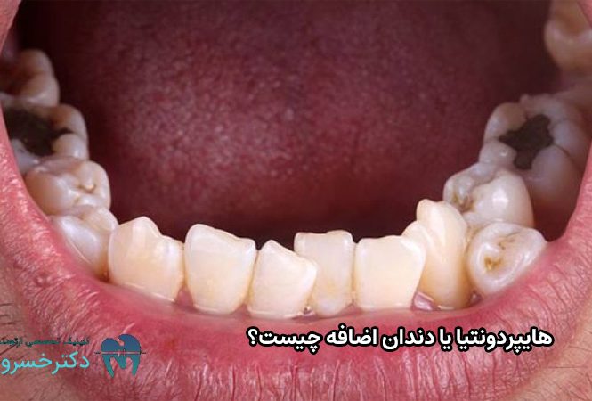 هایپردونتیا