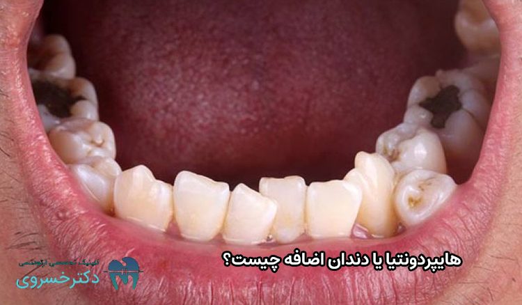 هایپردونتیا