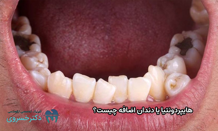 هایپردونتیا